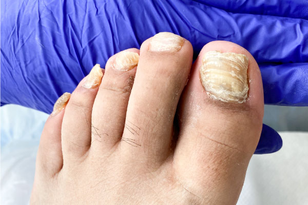 Hongos en uña del Pie