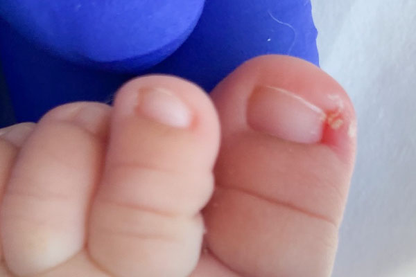 Uña encarnada Infanto Juvenil